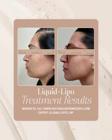 Liquid-Lipo treatment results at Naturalness Med Spa