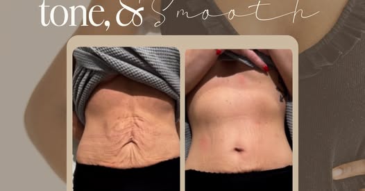 Body toning and smoothing treatment results
