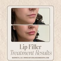 Lip filler treatment results at Naturalness Med Spa