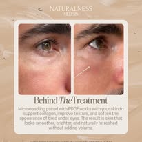 Microneedling with PRDP under-eye treatment