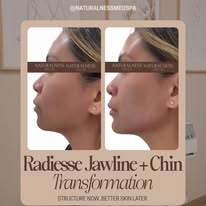 Radiesse jawline and chin transformation results